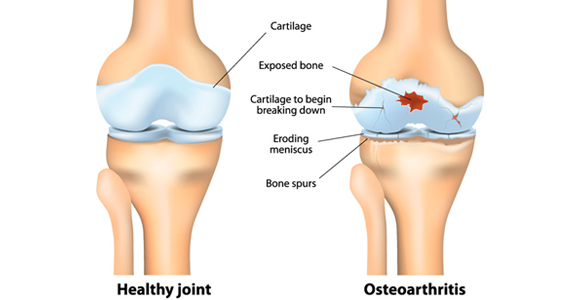 Complications of Knee and Ankle Cartilage Damage