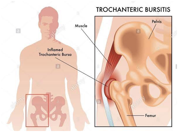 Hip Bursitis vs Arthritis: How to Tell the Difference - Heiden Orthopedics