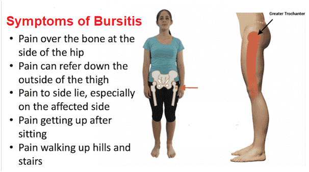 What can be misdiagnosed as bursitis?